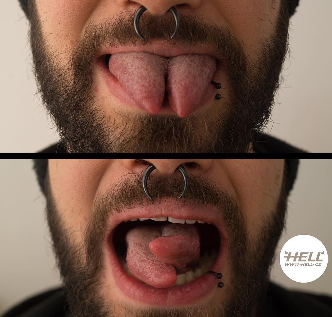Split tongue healing